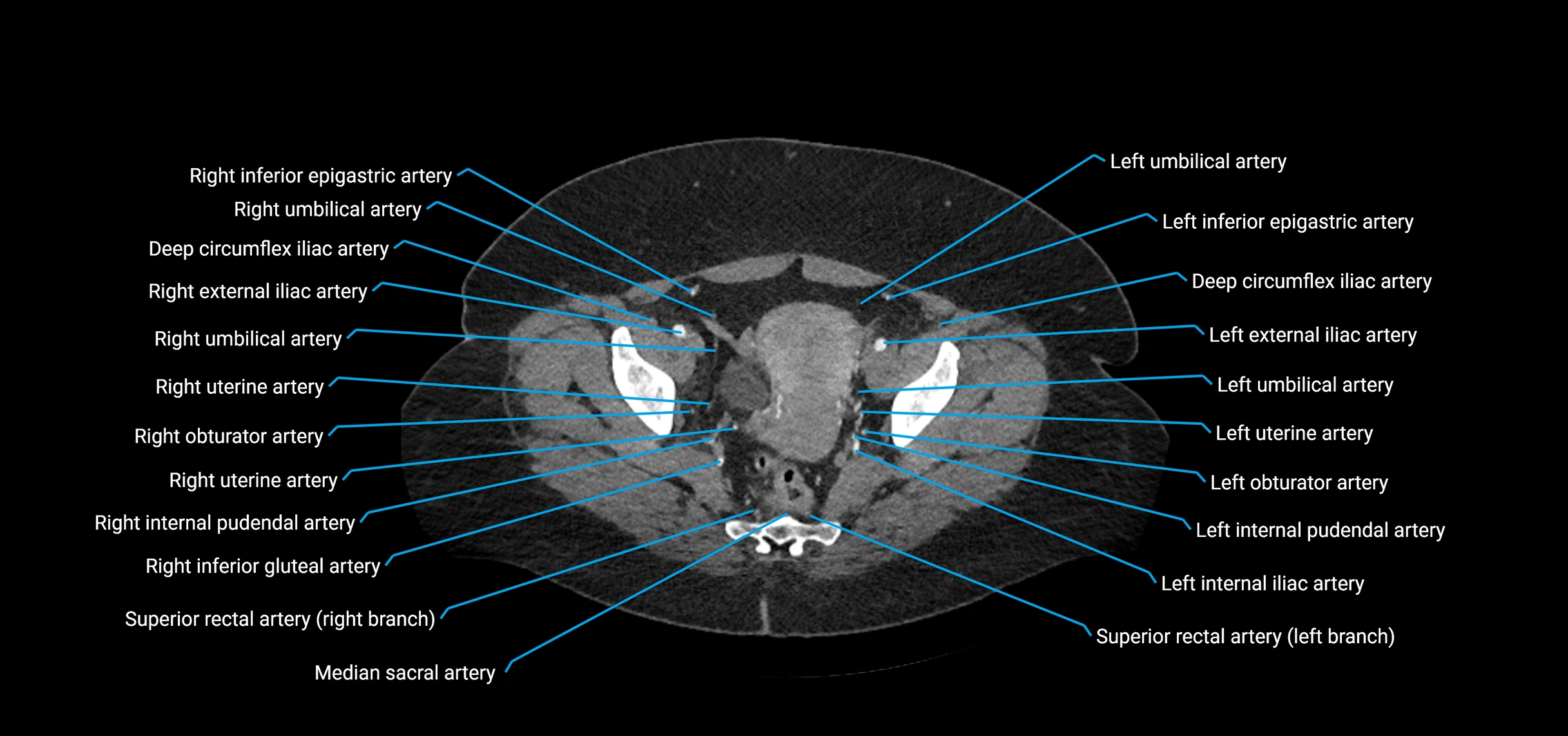 CTA abdomen axial cross sectional anatomy labelled image_221 (2).webp